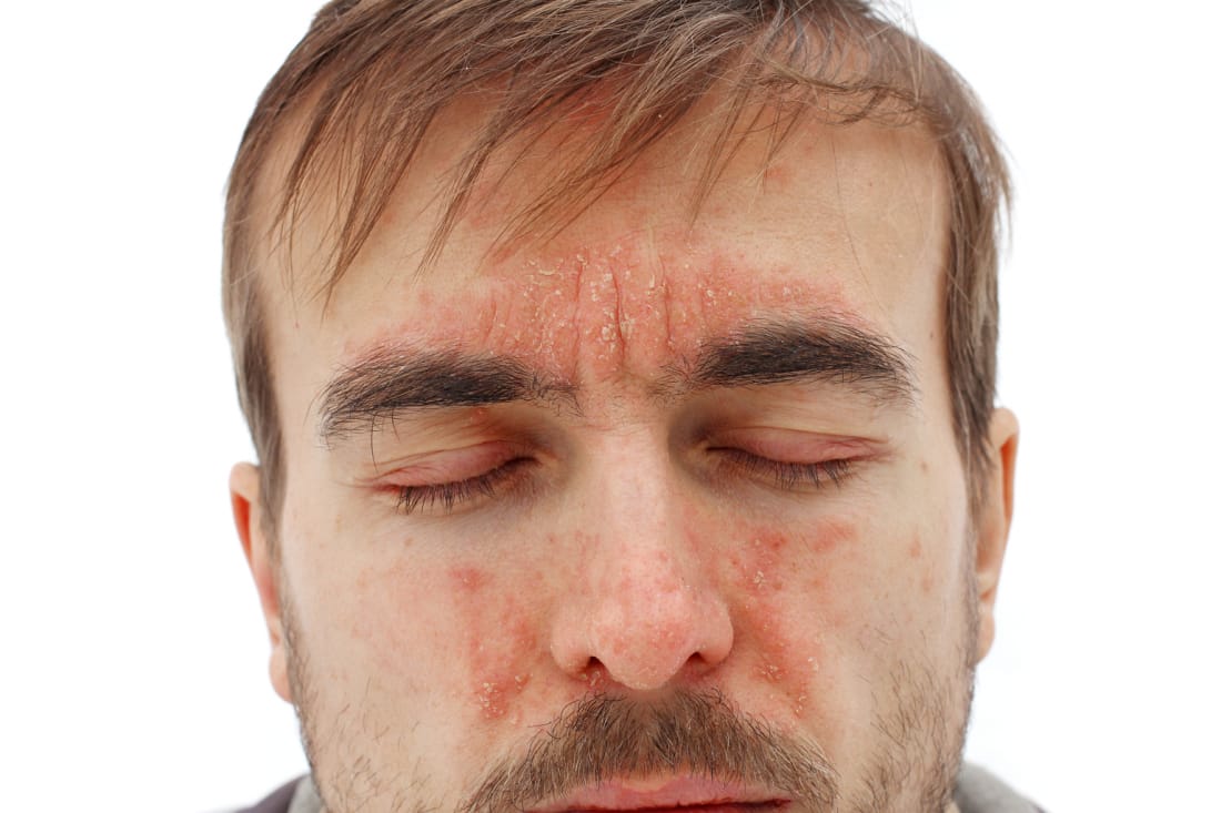 5 Common Men’s Skin Problems And How To Tackle Them Using Products You ...